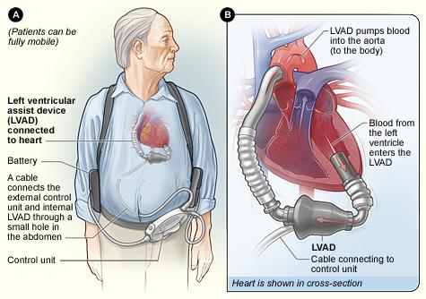 Illustration of a man with a LVAD in place